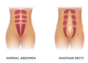 diastasis abdominal postparto